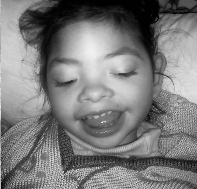 A Stephanie le diagnosticaron Síndrome de West. Tomaba seis pastillas diarias, sin resultado. La epilepsia empeoró y se tranformó Síndrome de Lennox-Gastaut. El aceite de cannabis, la ayudó a subir de peso, aceptar el tratamiento y disminuir las convulsiones.